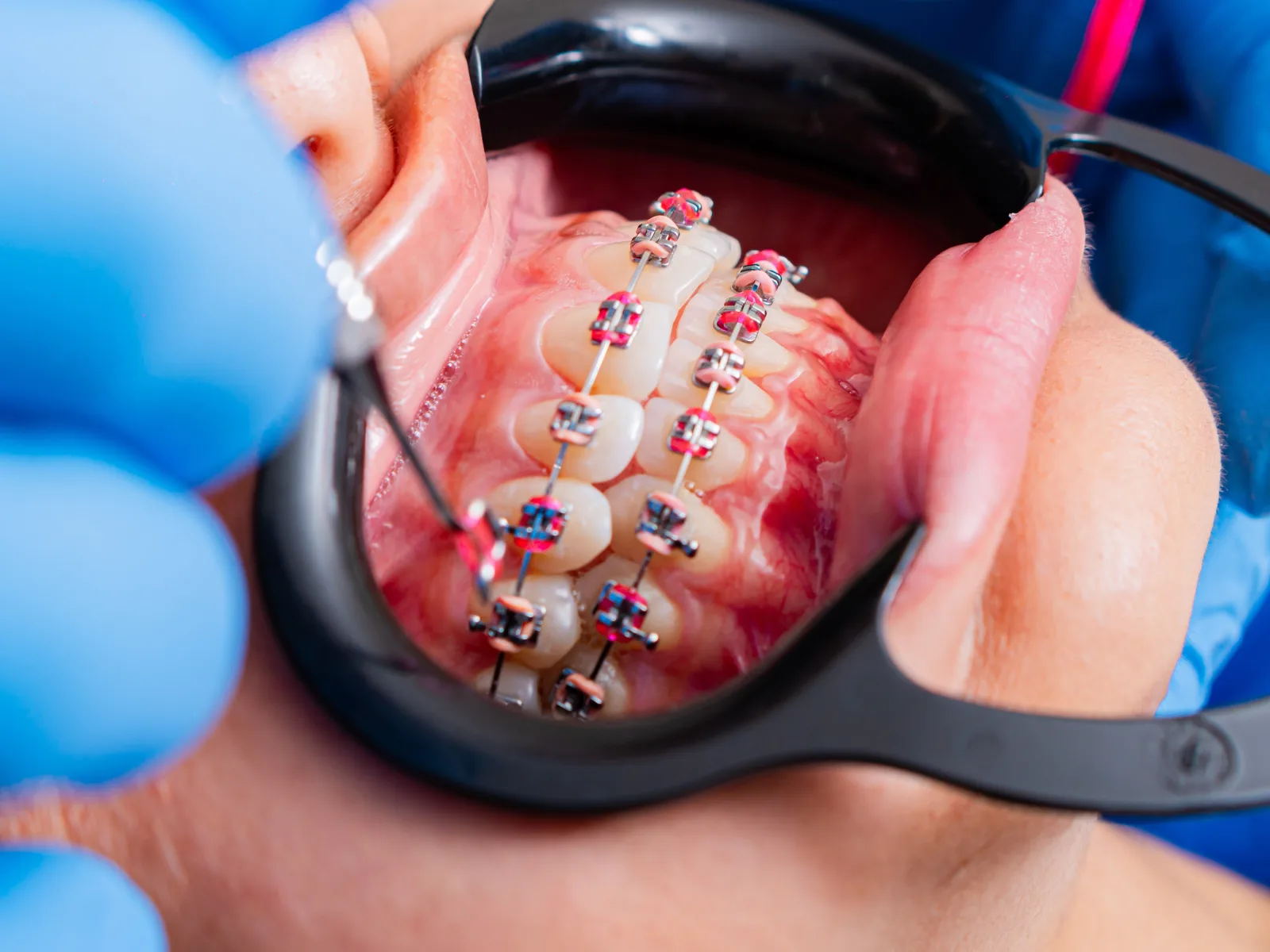 Brackets metálicos con ligaduras instalados en la arcada superior e inferior de un paciente