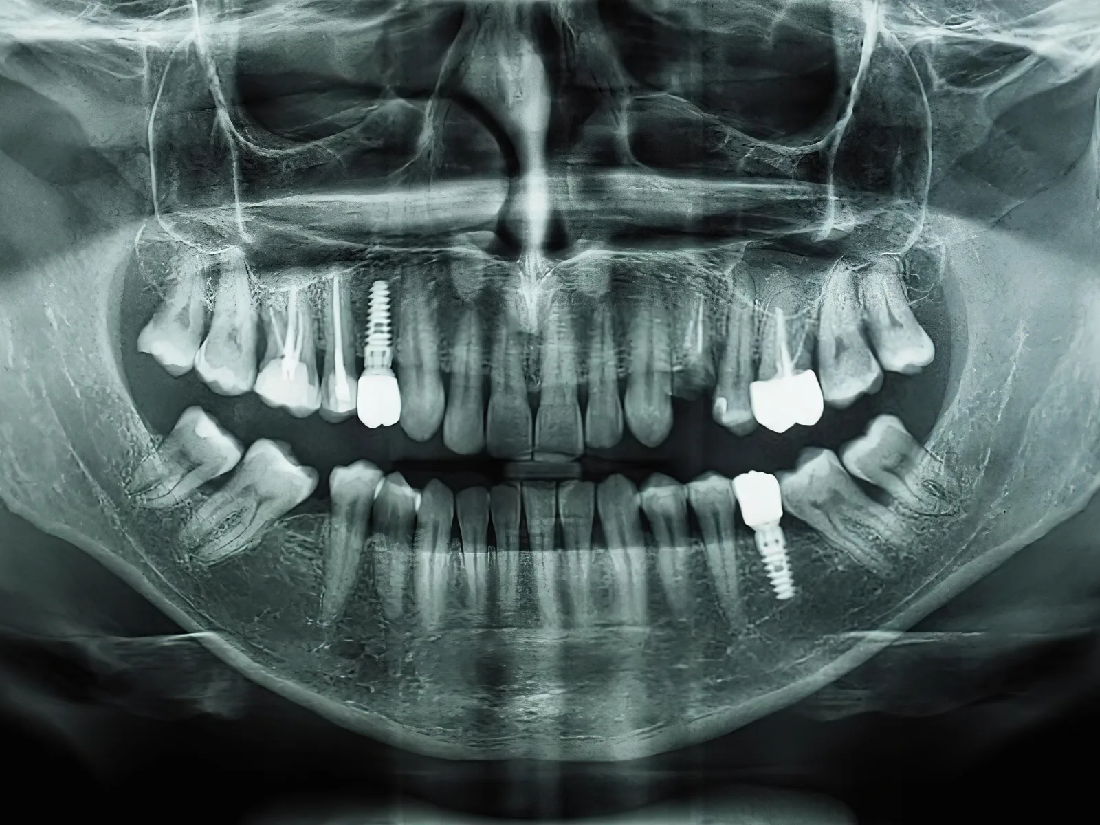 Radiografía panorámica dental con ambas arcadas completas y las raíces de los dientes visibles